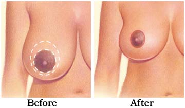 Breast Reduction Surgery, Breast Reduction Surgery India, Cost Breast Reduction